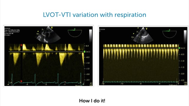 What is the LV outflow VTI?