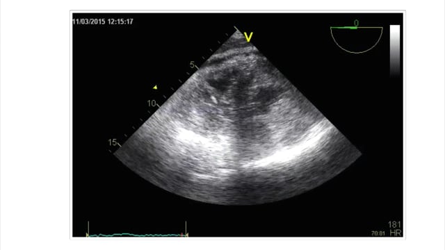 Can I use echo to estimate volume status without doing measurements?