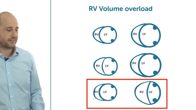 Can I use echo to estimate and monitor change in fluid status after intervention?