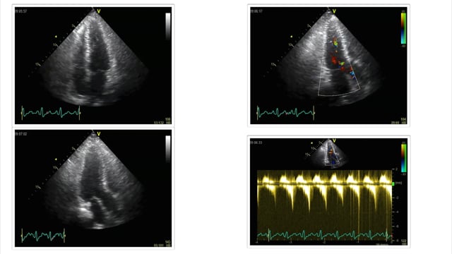 What are the best ways to assess volume status using echocardiography?