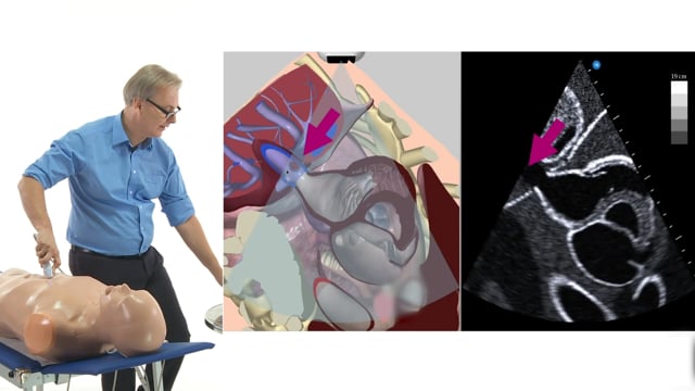 What are tips for imaging the IVC with echocardiography?