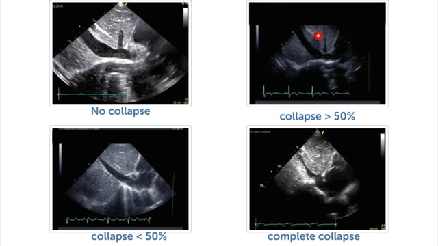 What does an abnormal IVC look like in echo?