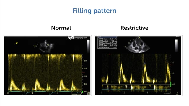 How can I use hemodynamic parameters to find hypervolemia?