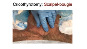 (Update) Emergency Cricothyrotomy (eFONA)