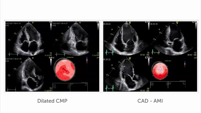 How can strain differentiate between ischemic and dilated CMP?