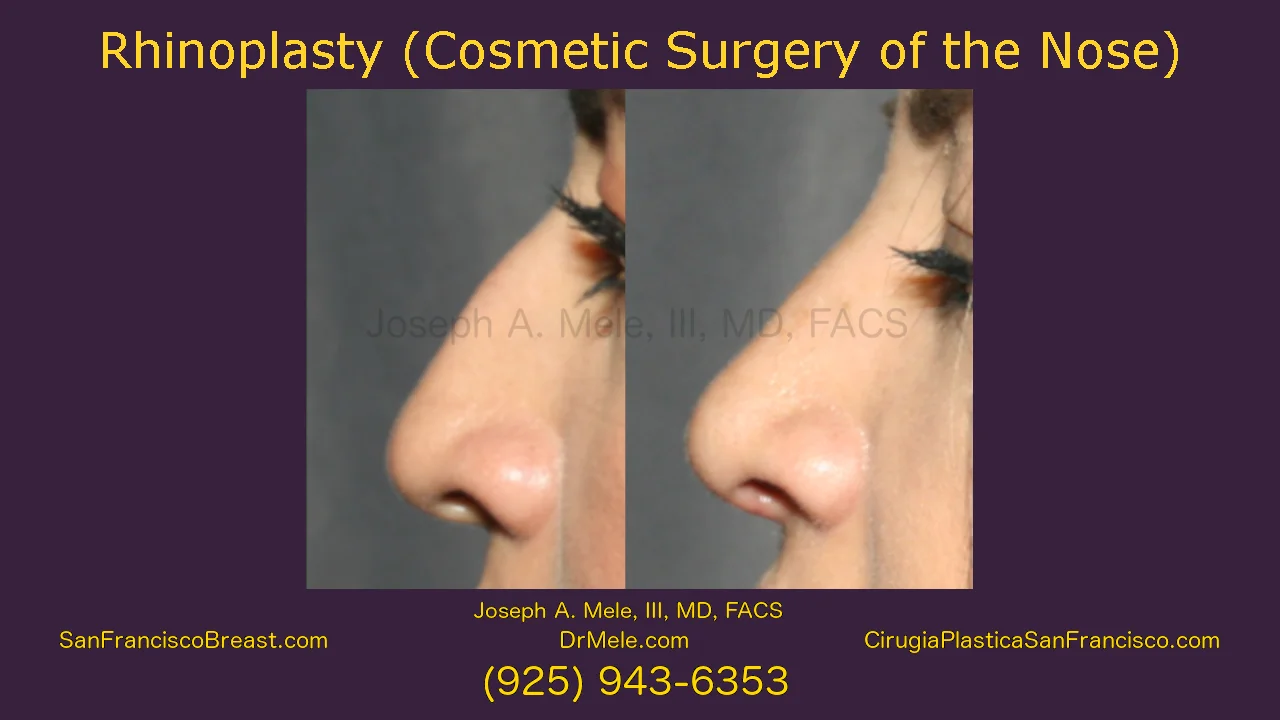 elfbar nachfüll pod läuft aus Revision Rhinoplasty 2.5 month post-op update : r/PlasticSurgery main image 1