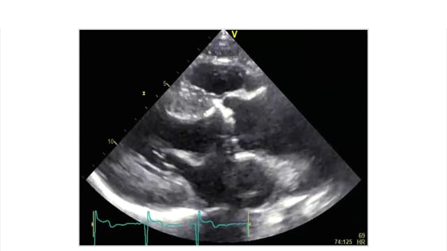 What are secondary signs to consider and recognize when scanning a patient with aortic stenosis?