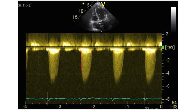 How can I use the Bernoulli equation to evaluate aortic stenosis?