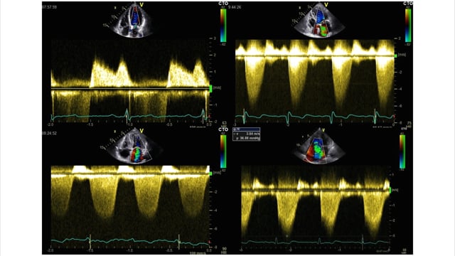 How can I use Doppler imaging to assess the aortic valve?