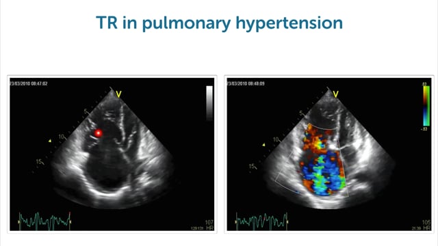 What are some examples of tricuspid regurgitation on echo?