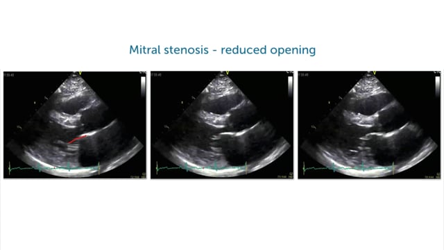 What echo signs are there for mitral stenosis and rheumatic heart disease?