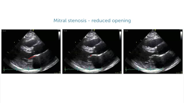 How can I use the short-axis view to assess mitral stenosis?