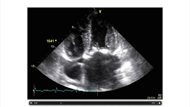 What are signs of mitral stenosis in TEE and TTE?