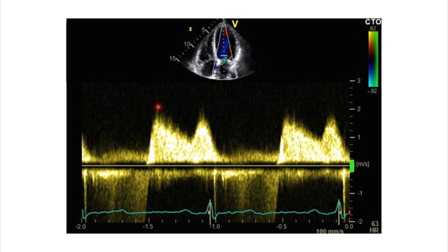 How can I use Doppler ultrasound to assess the mitral valve?