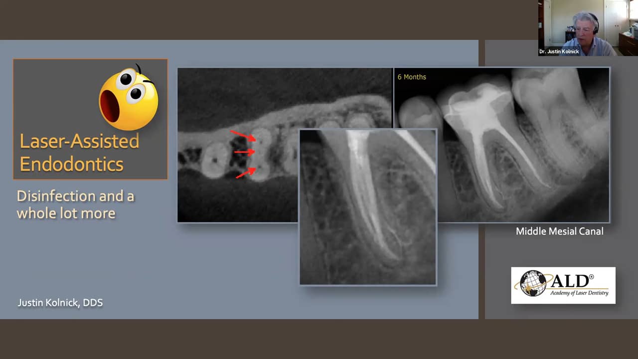 LaserAssisted Endodontics Disinfection and a Whole Lot More on Vimeo