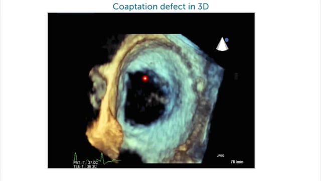 What are the different zones in a color Doppler study of mitral regurgitation?