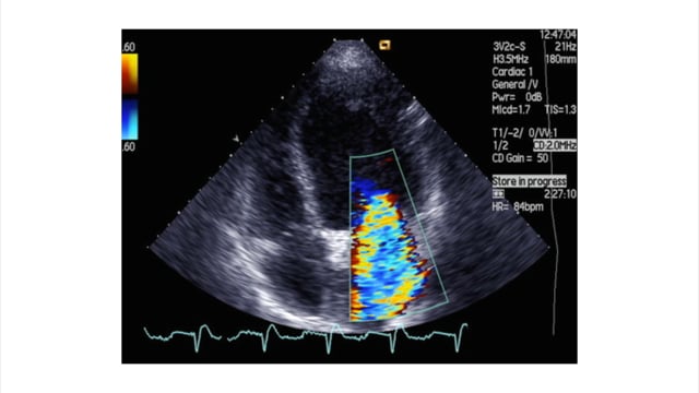 How is vena contracta used in assessing mitral regurgitation?