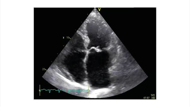 How does acute mitral regurgitation differ from chronic?