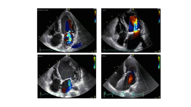 Quiz: How severe is MR in these patients?