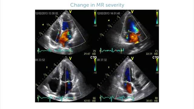 Can the degree of mitral regurgitation change over time?