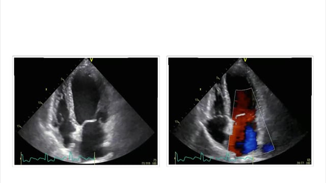 How does mitral regurgitation correlate with left ventricular function?