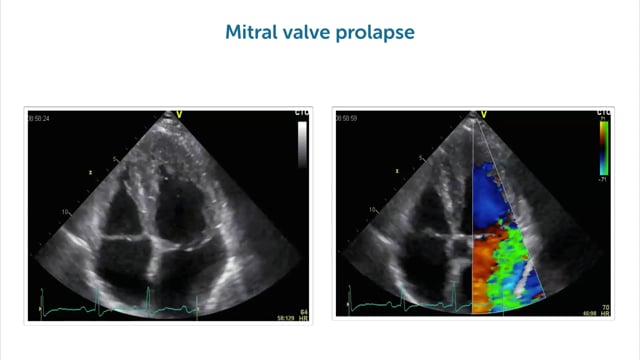 Which pathologies can create a structural reason for mitral regurgitation?
