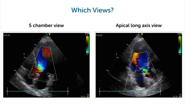 How can I find aortic regurgitation with echo?