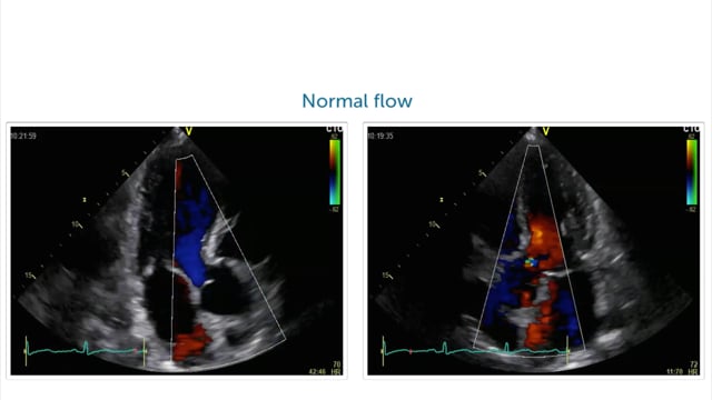 Can you detect aortic regurgitation in these patients?