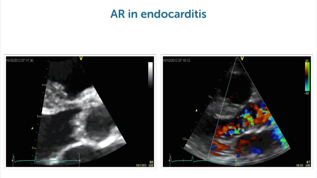 What does aortic regurgitation in endocarditis look like?