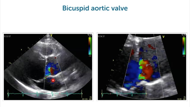 What are the causes of aortic regurgitation?