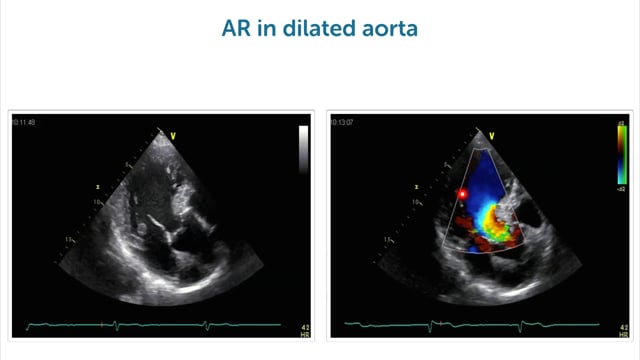 How does aoric dilatation lead to regurgitation?