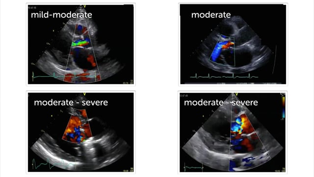 Which of these aortic regurgitations are severe?