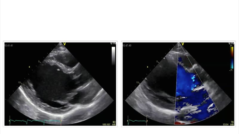 What are the consequences of significant aortic regurgitation?