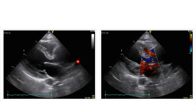 Case: patient with only aortic regurgitation?