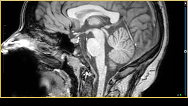 cerebellum anatomy mri