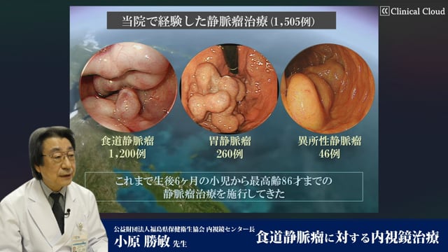 小原 勝敏先生：食道静脈瘤に対する内視鏡治療 Part1