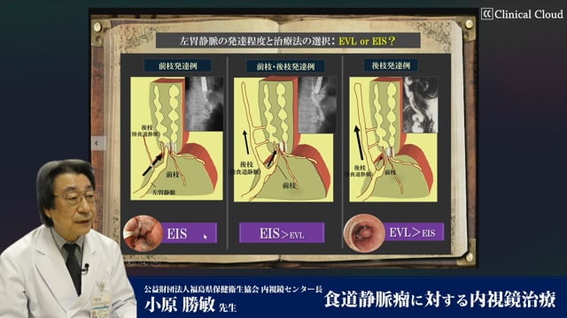 小原 勝敏先生：食道静脈瘤に対する内視鏡治療 Part2
