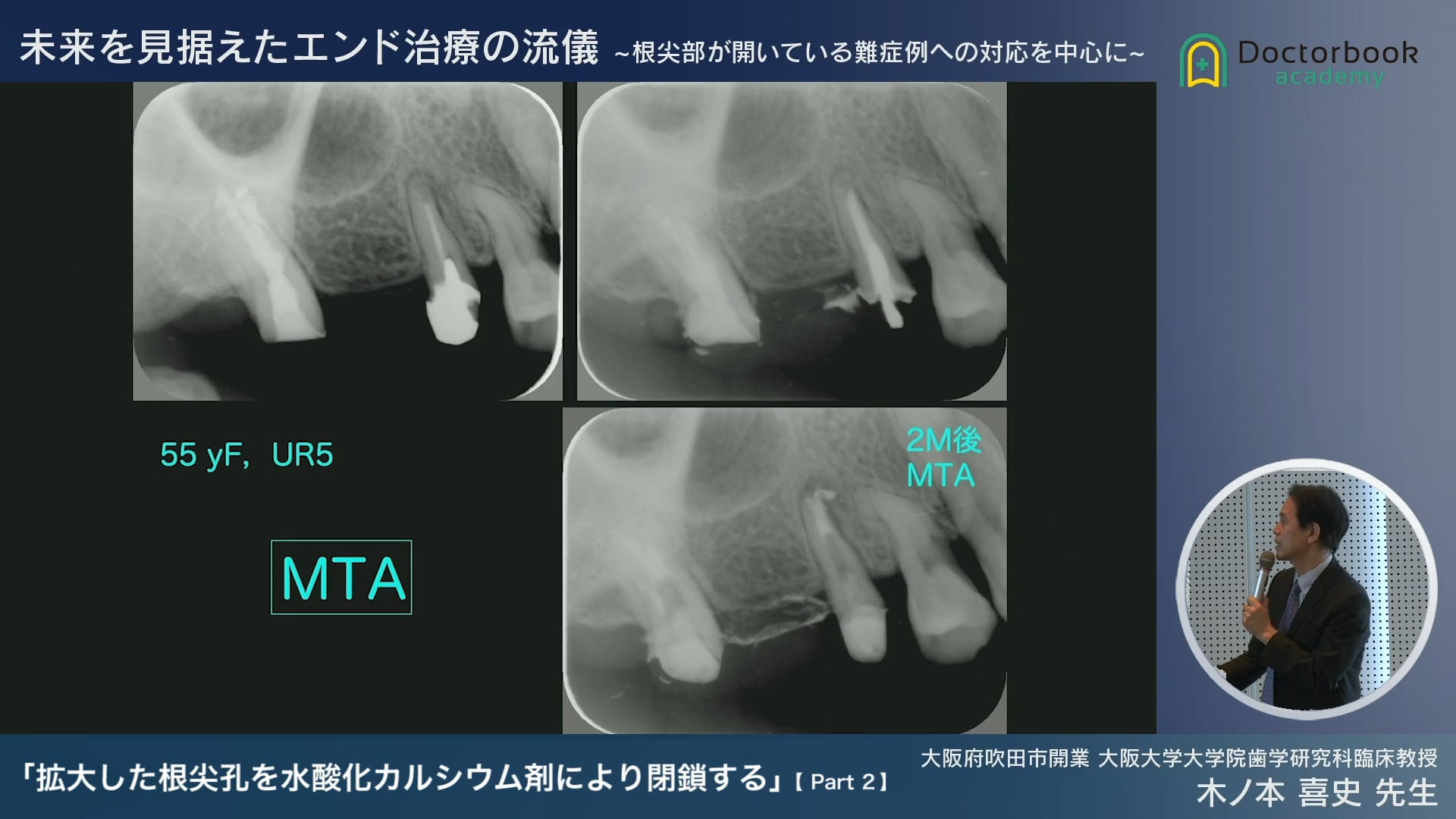 MTA症例 #2