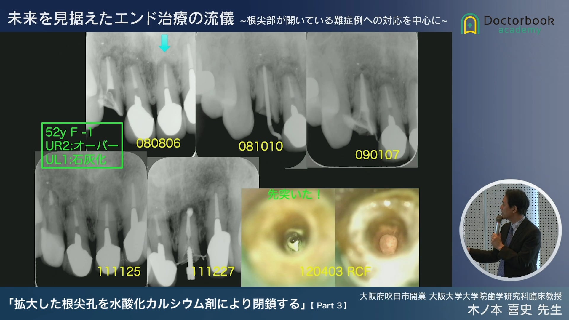 石灰化症例 #3