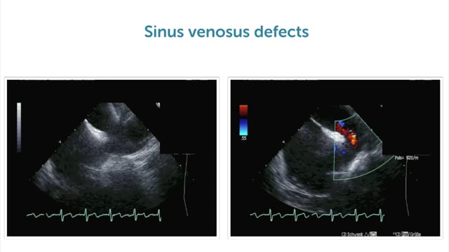 What are indications for performing a TEE study?