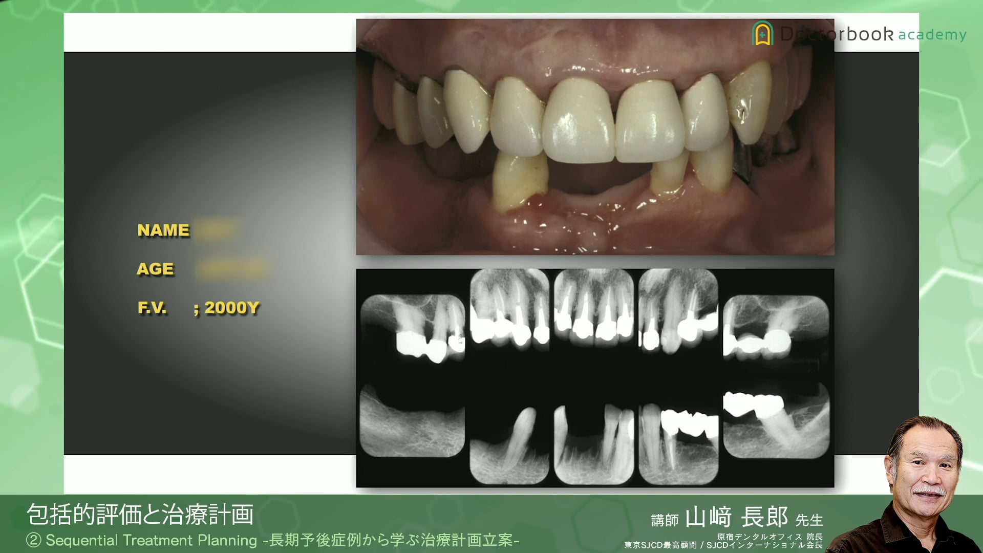 #2 Sequential Treatment Planning -長期予後症例から学ぶ治療計画立案-