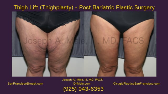 🥇 NYC Thigh Lift (Thighplasty), Manhattan Thigh Plastic Surgery