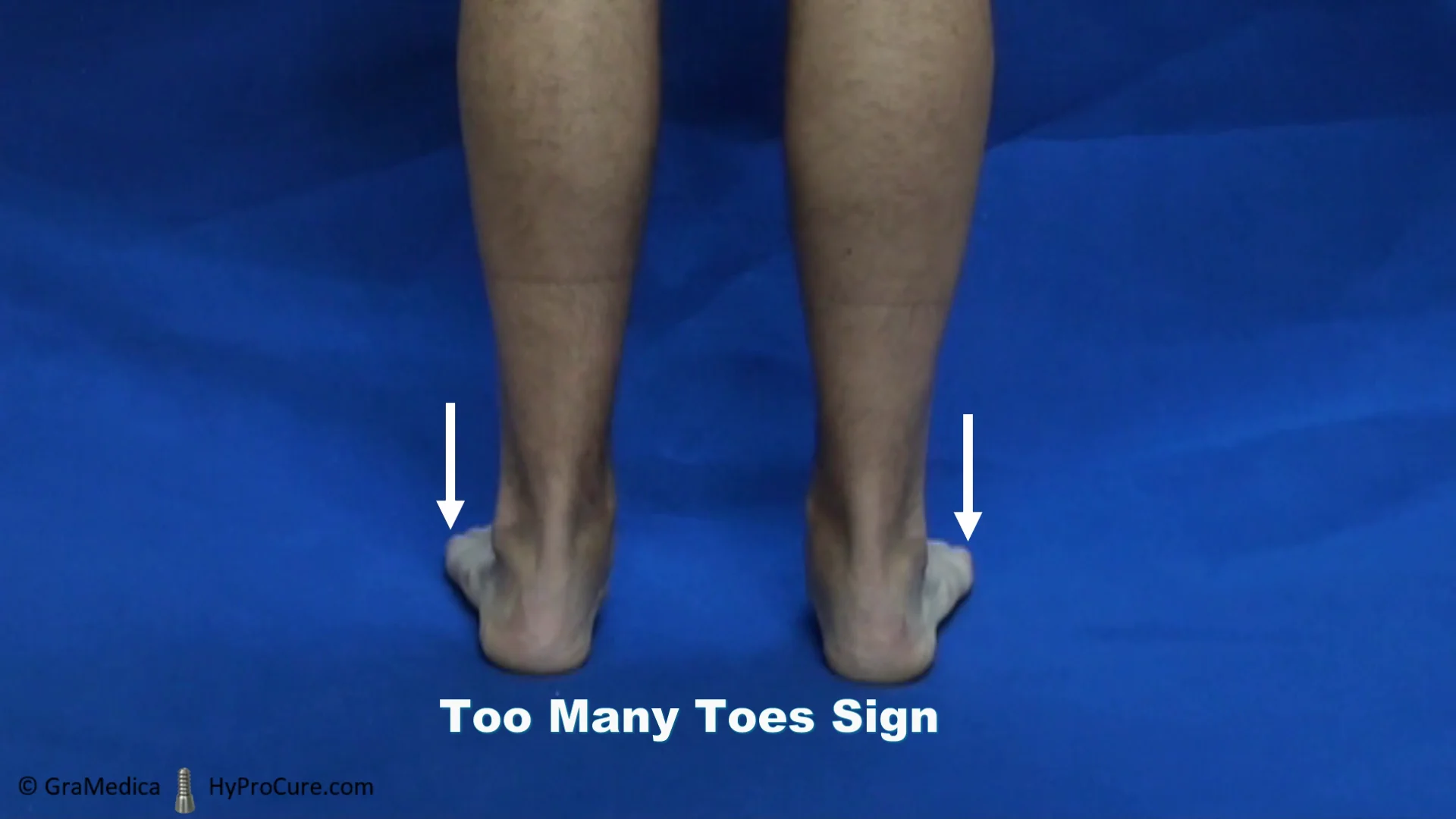 This figure shows 'too many toes sign' in right side. When looking