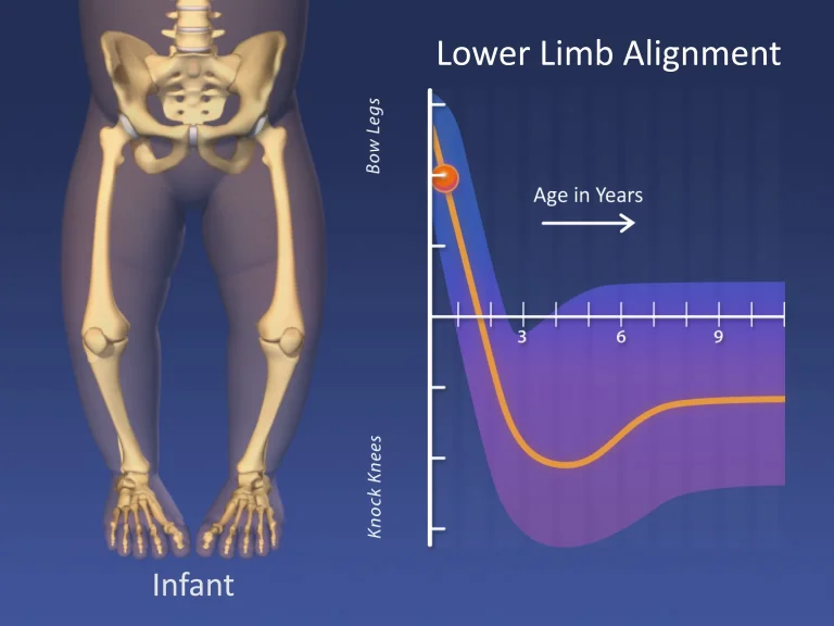 Lower Limb Alignment