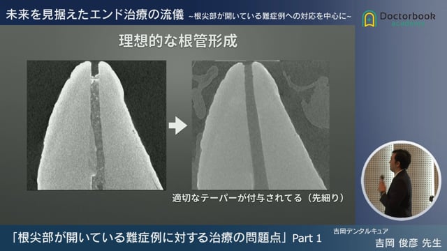 根尖部が開いている難症例に対する治療の問題点 | Doctorbook academy 