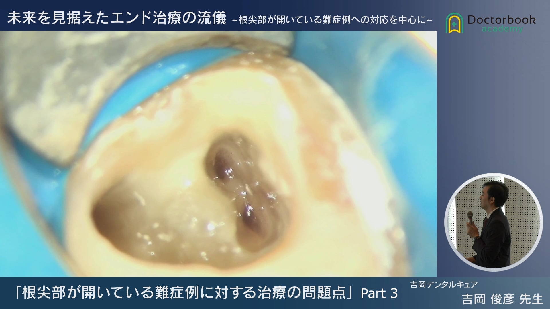 Amazon.co.jp: MI時代の歯科知識 プラークコントロール
