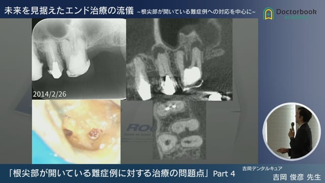 根尖部が開いている難症例に対する治療の問題点 | Doctorbook academy 