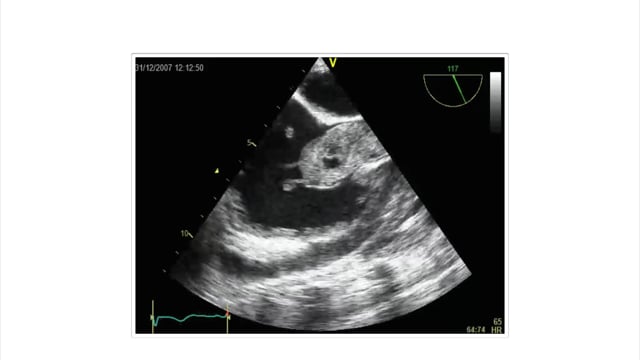 How can intracardial thrombi be detected using TEE?