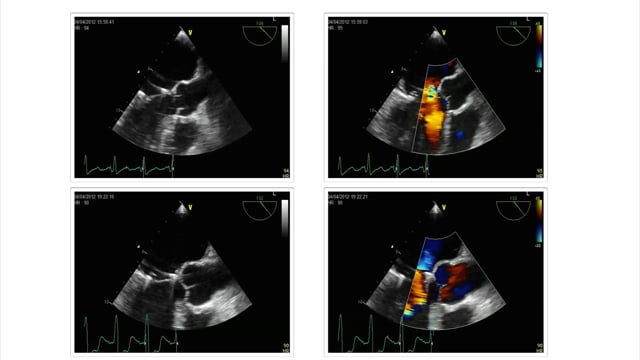 What are typical diseases of the mitral valve that can be detected using TEE?