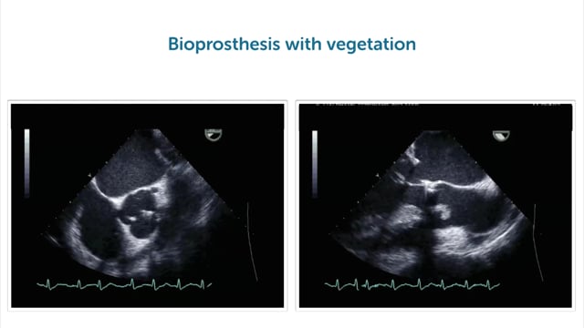 What are typical diseases of the aortic valve that can be detected using TEE?